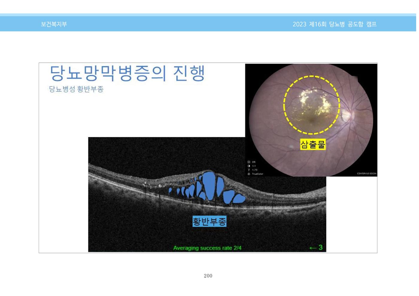 한국소아당뇨인협회 16회 공도함 캠프 E북 자료집 200페이지