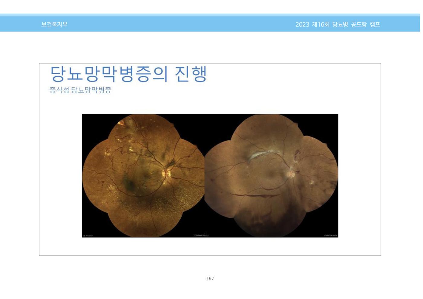 한국소아당뇨인협회 16회 공도함 캠프 E북 자료집 197페이지