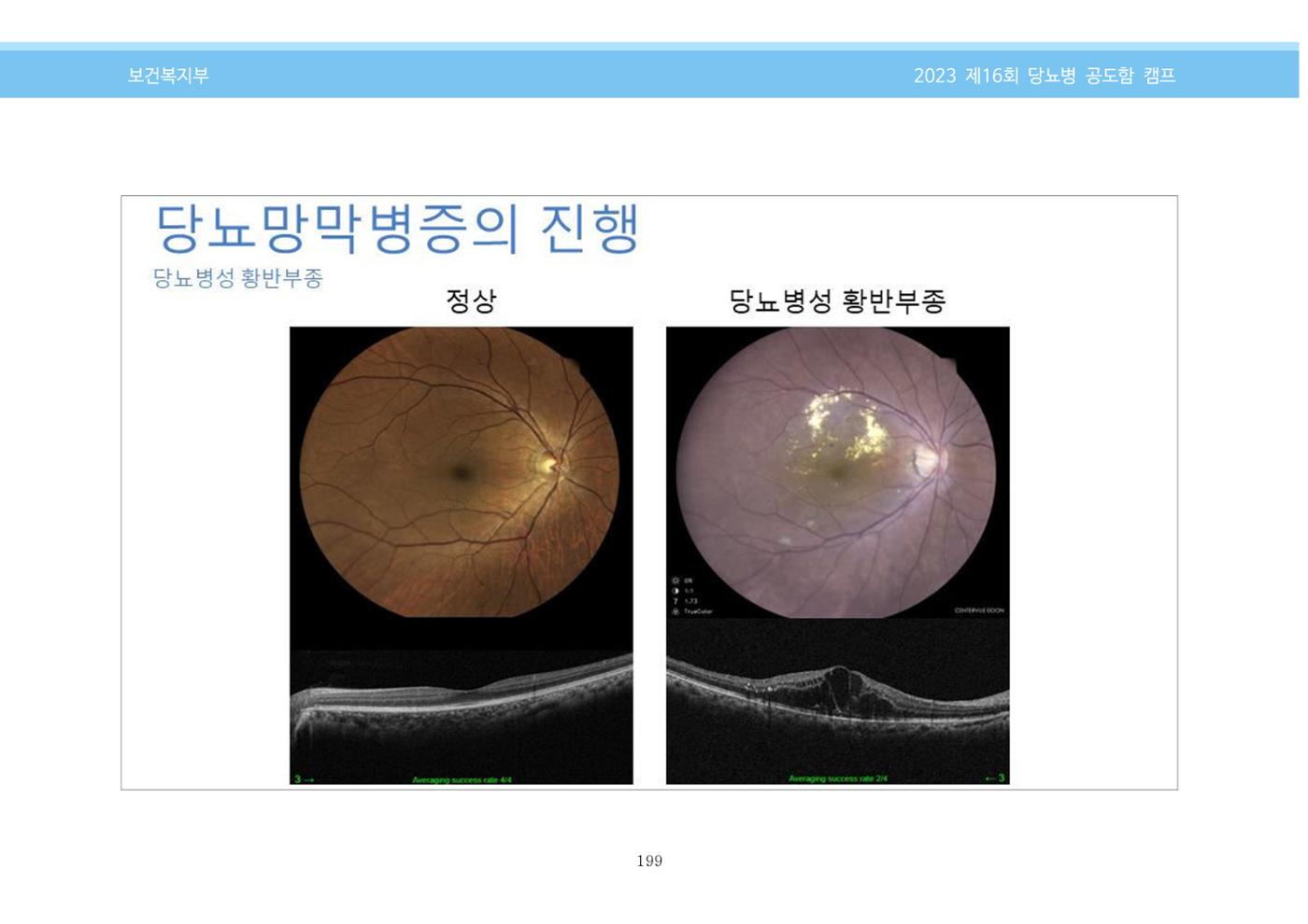 한국소아당뇨인협회 16회 공도함 캠프 E북 자료집 199페이지