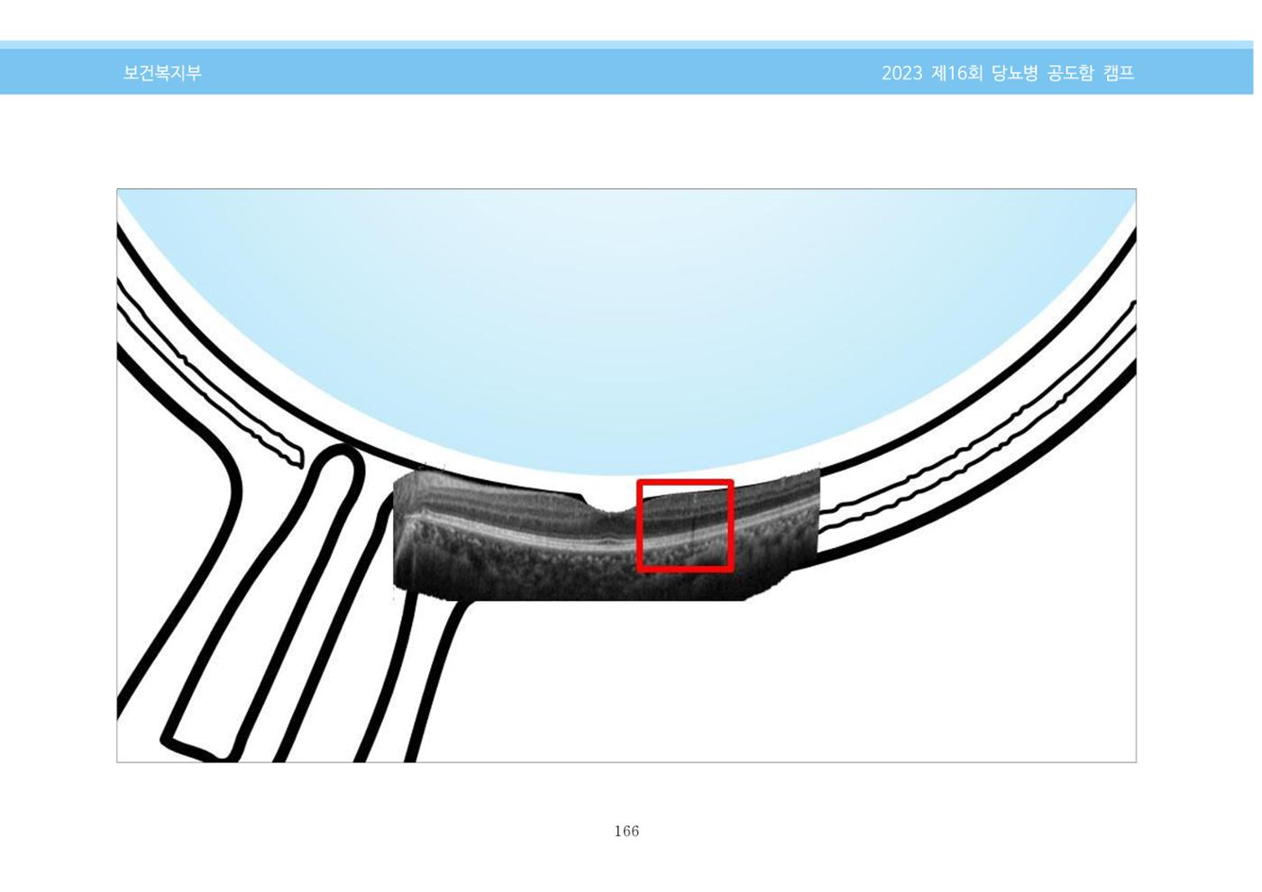 한국소아당뇨인협회 16회 공도함 캠프 E북 자료집 166페이지