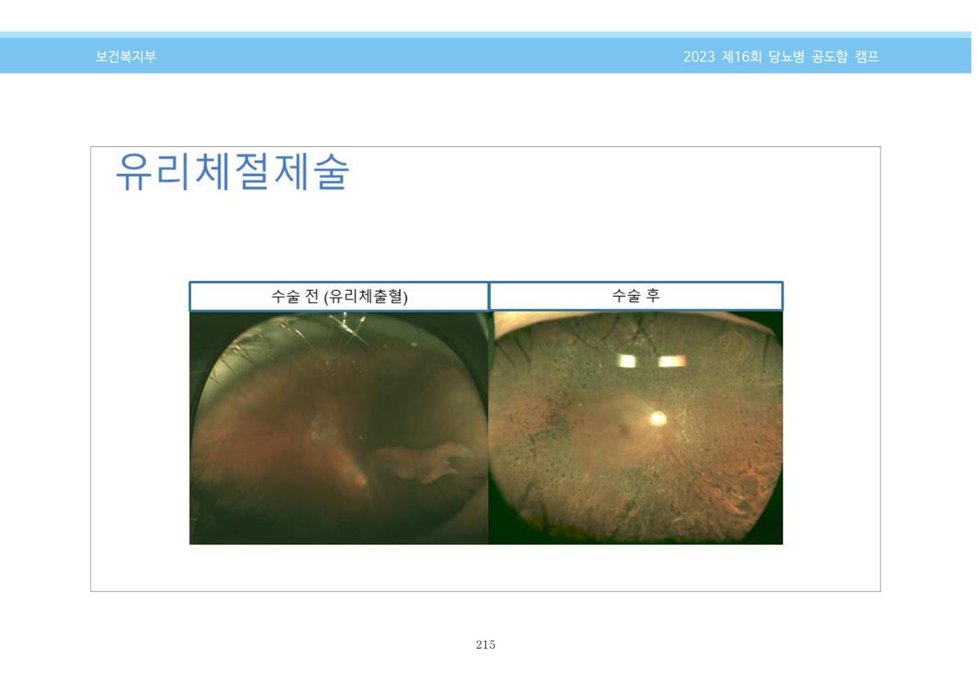 한국소아당뇨인협회 16회 공도함 캠프 E북 자료집 215페이지