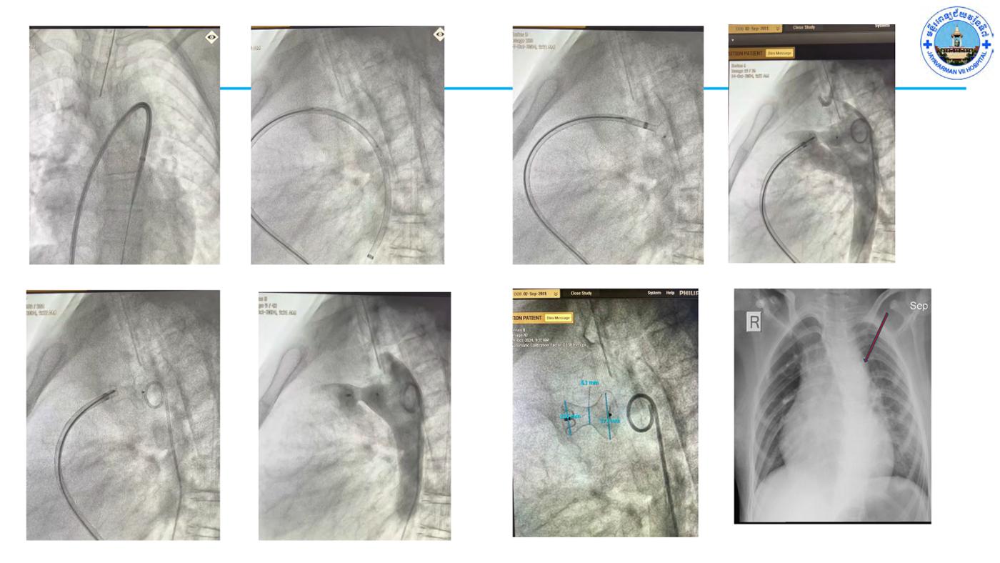 2025 Pediatric Heart Forum Presentation 69페이지
