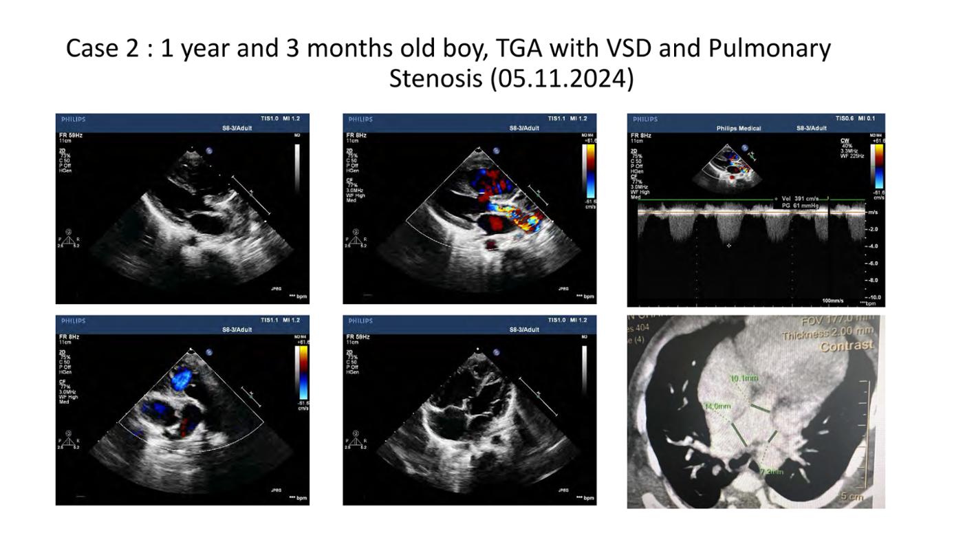 2025 Pediatric Heart Forum Presentation 401페이지