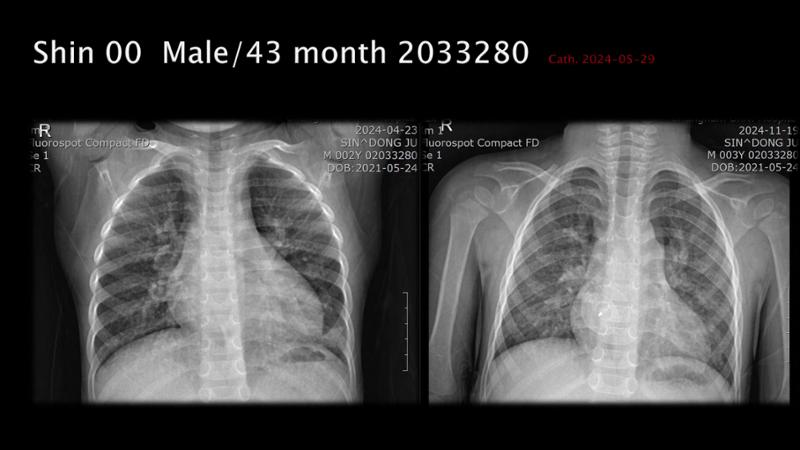 2025 Pediatric Heart Forum Presentation 125페이지
