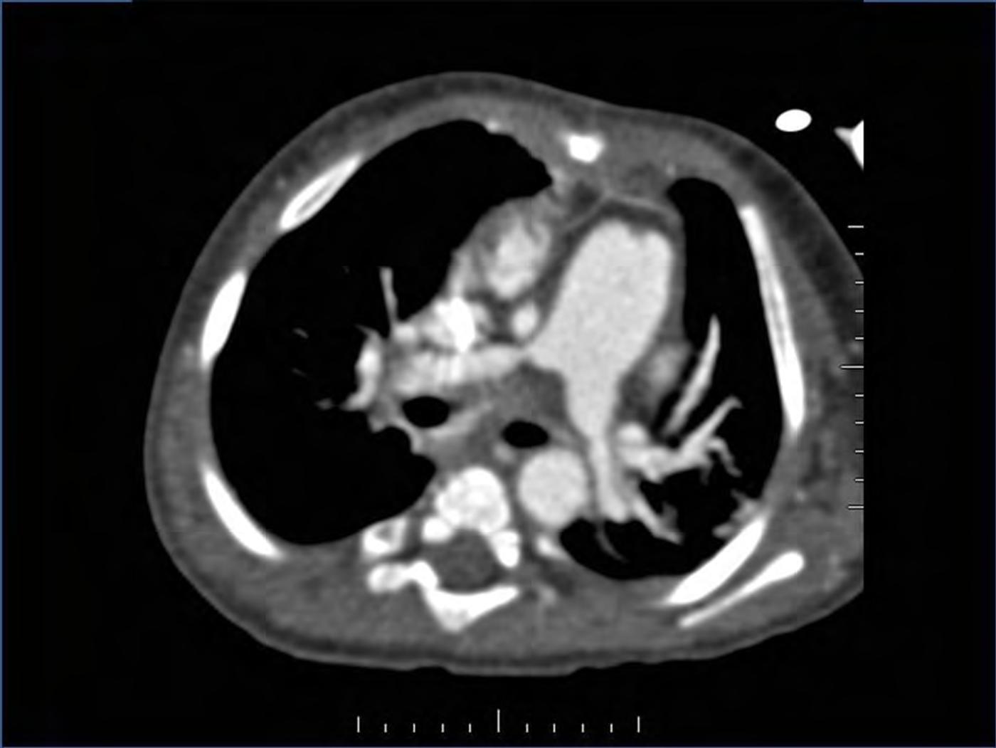 2025 Pediatric Heart Forum Presentation 339페이지