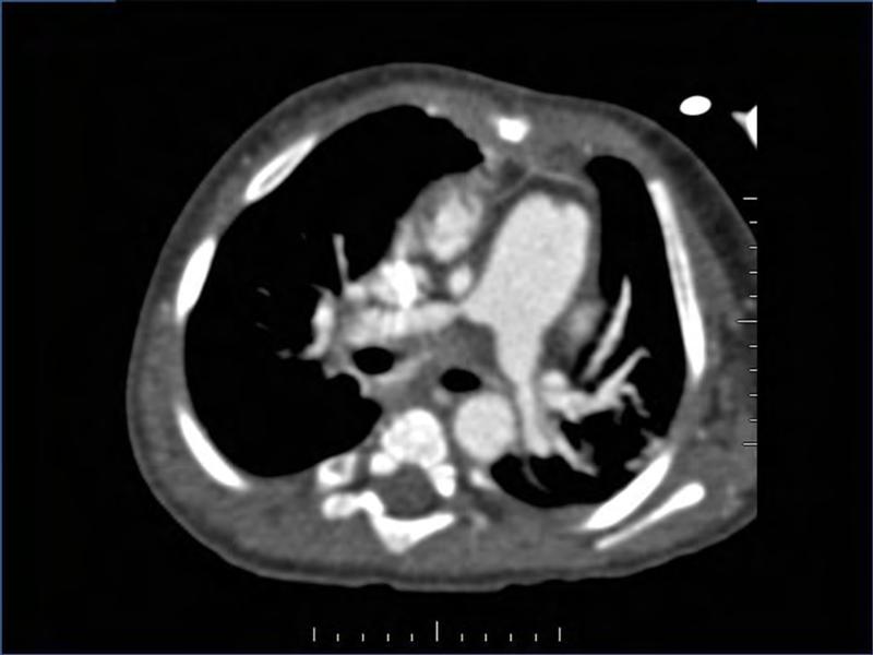 2025 Pediatric Heart Forum Presentation 339페이지