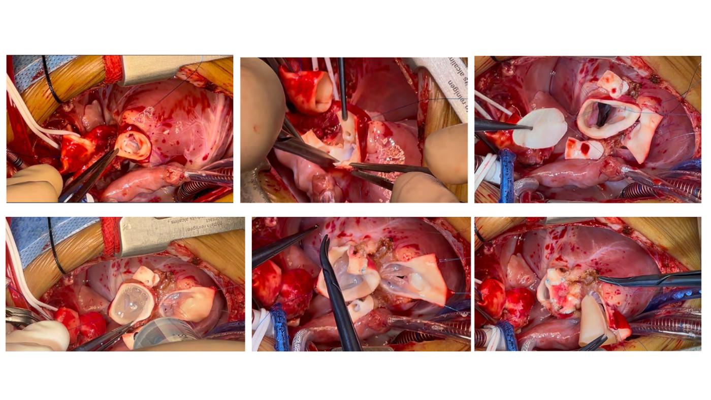 2025 Pediatric Heart Forum Presentation 393페이지