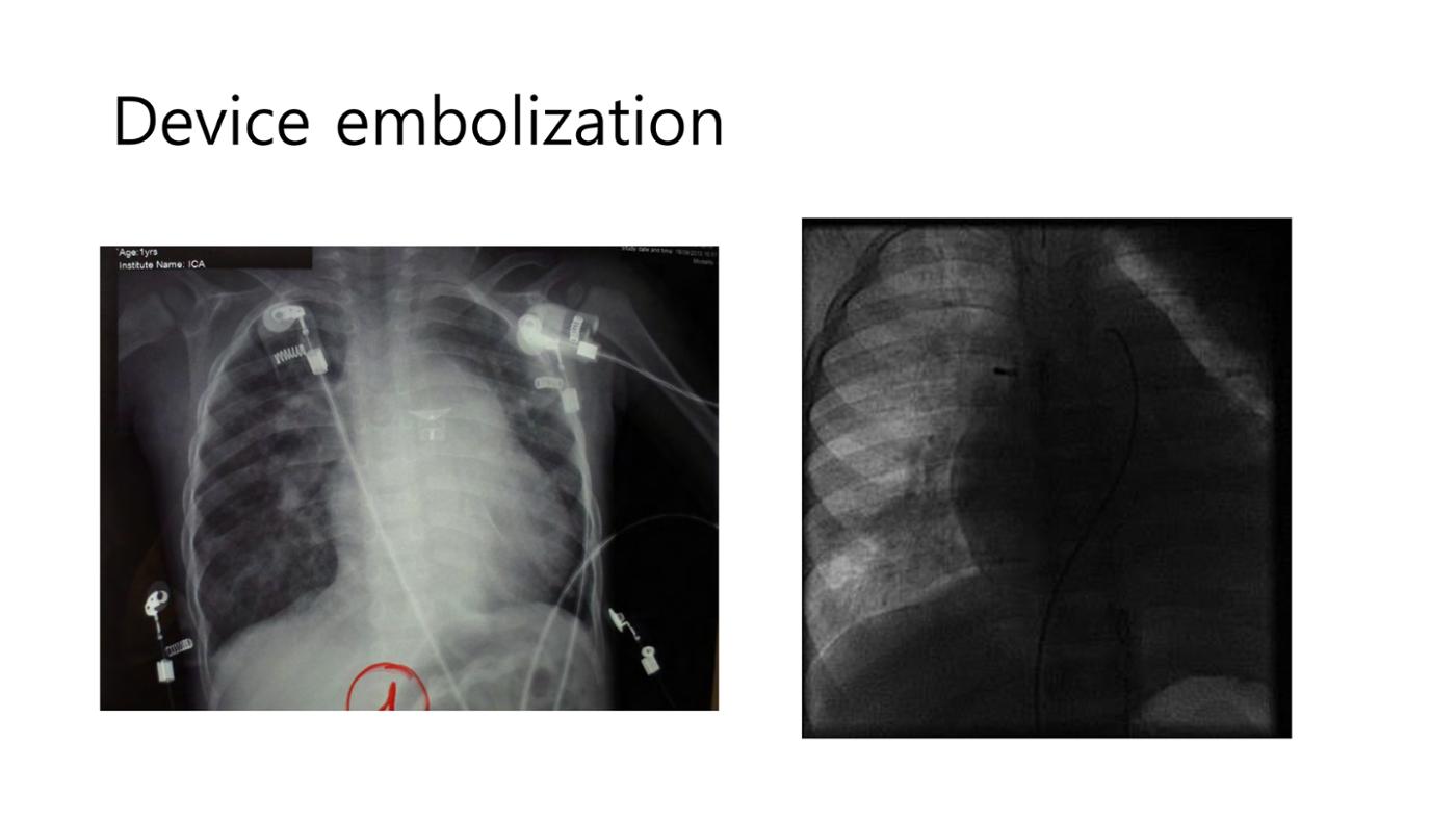 2025 Pediatric Heart Forum Presentation 41페이지
