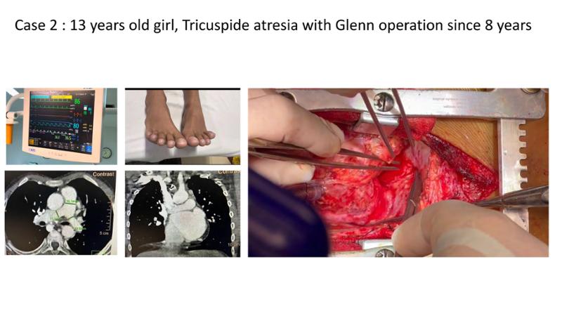 2025 Pediatric Heart Forum Presentation 387페이지