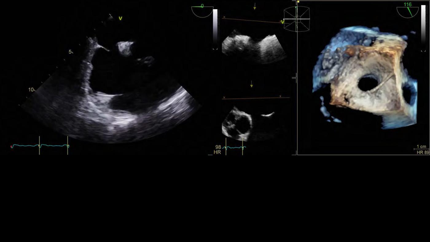 2025 Pediatric Heart Forum Presentation 87페이지
