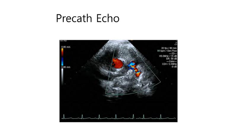 2025 Pediatric Heart Forum Presentation 29페이지
