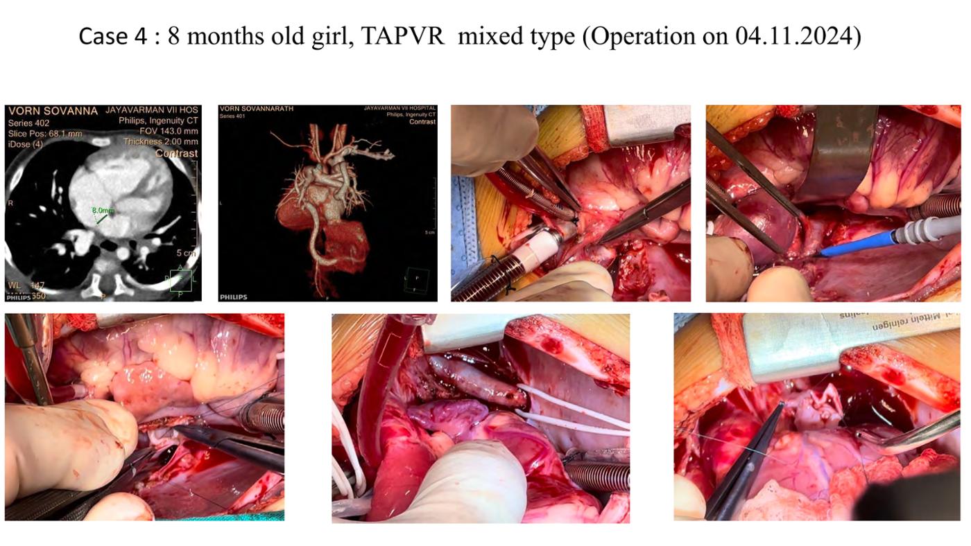 2025 Pediatric Heart Forum Presentation 377페이지