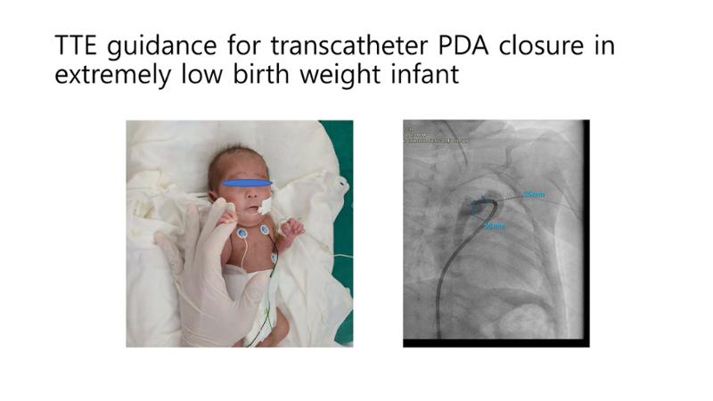 2025 Pediatric Heart Forum Presentation 35페이지