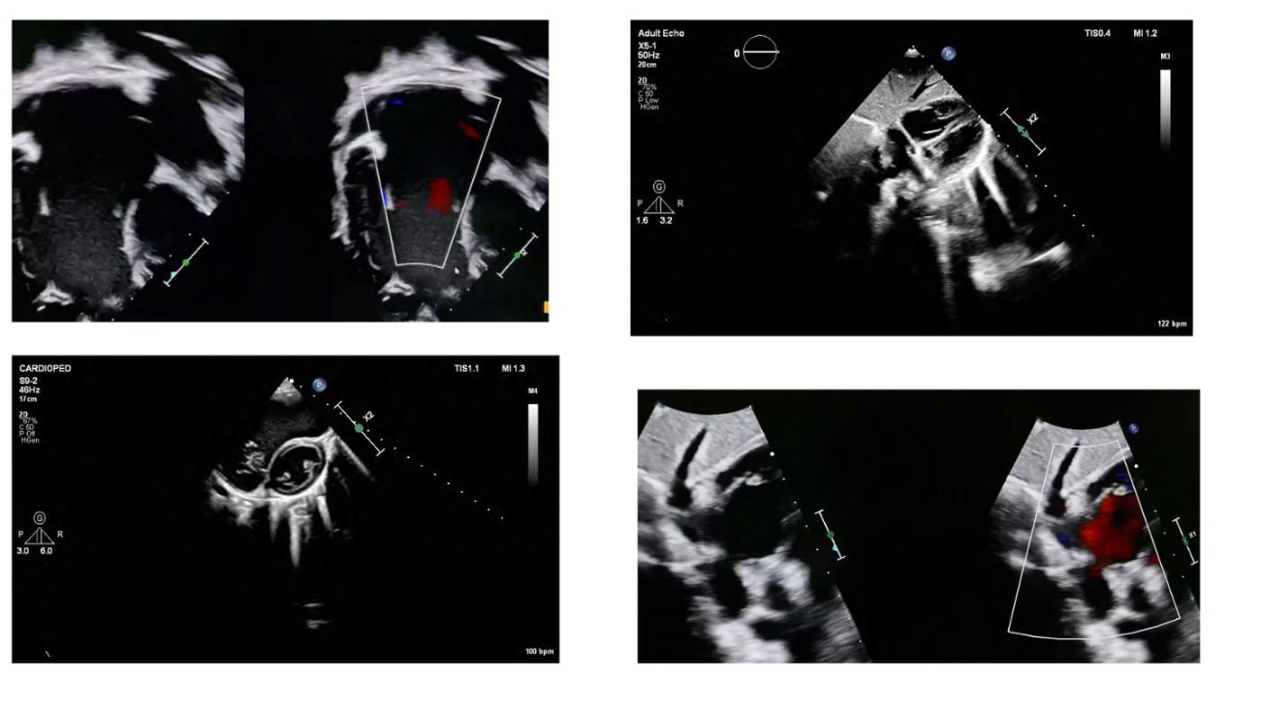 2025 Pediatric Heart Forum Presentation 152페이지