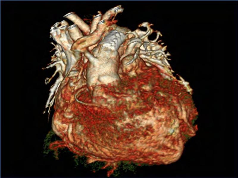 2025 Pediatric Heart Forum Presentation 338페이지