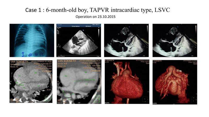 2025 Pediatric Heart Forum Presentation 372페이지