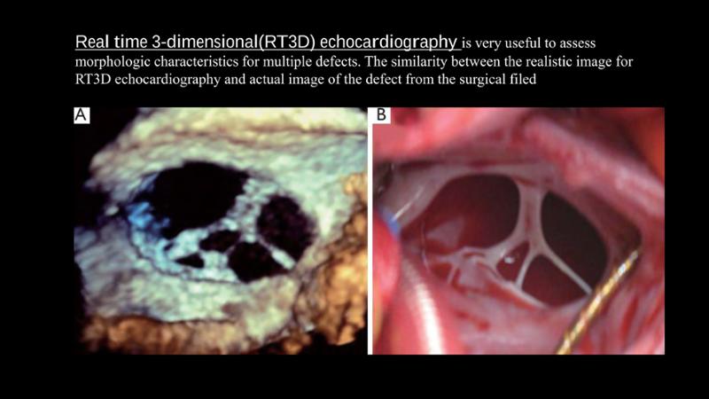 2025 Pediatric Heart Forum Presentation 107페이지