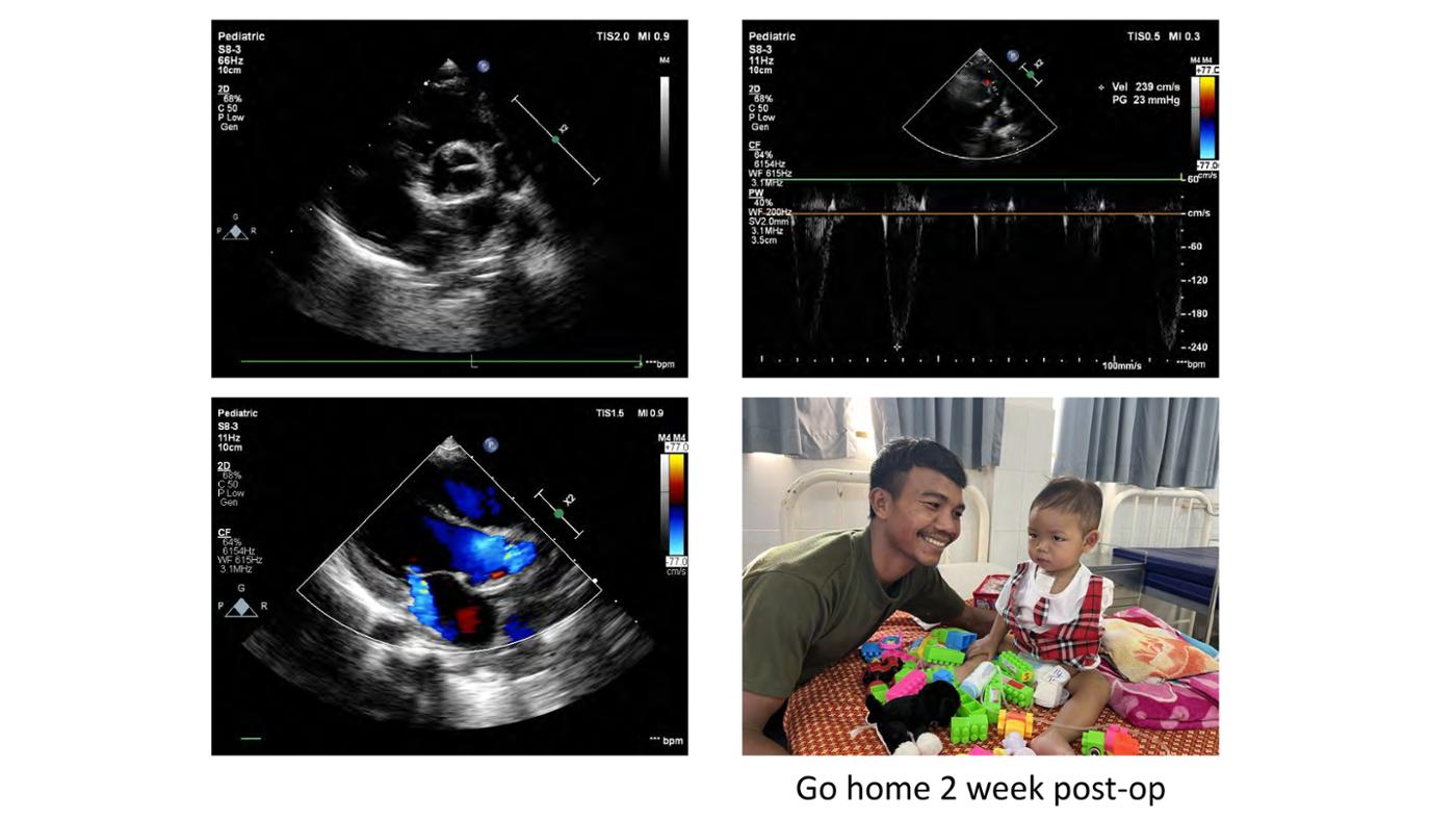 2025 Pediatric Heart Forum Presentation 404페이지