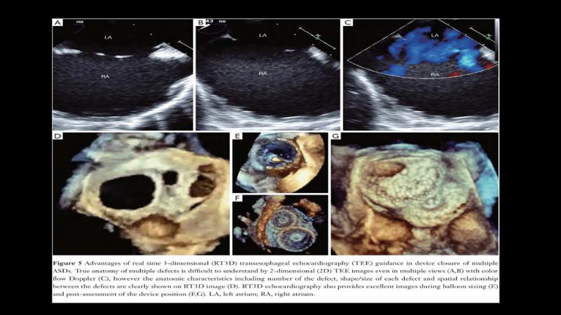 2025 Pediatric Heart Forum Presentation 109페이지