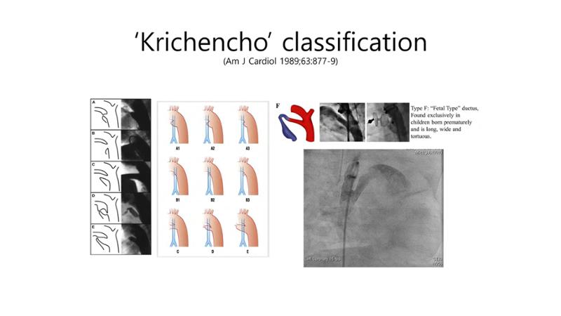 2025 Pediatric Heart Forum Presentation 19페이지