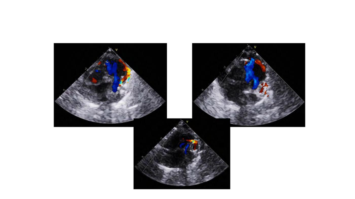 2025 Pediatric Heart Forum Presentation 36페이지