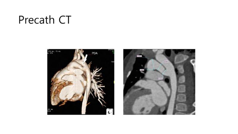 2025 Pediatric Heart Forum Presentation 30페이지
