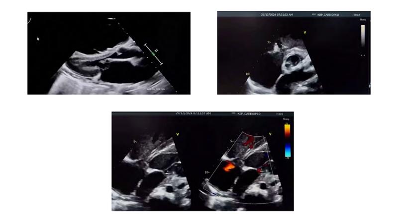 2025 Pediatric Heart Forum Presentation 153페이지