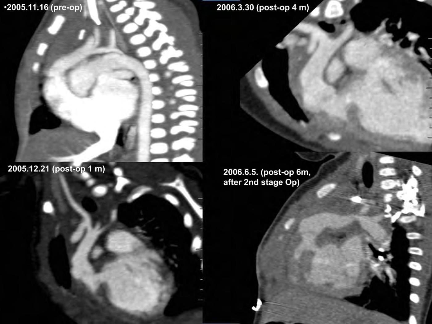 2025 Pediatric Heart Forum Presentation 333페이지