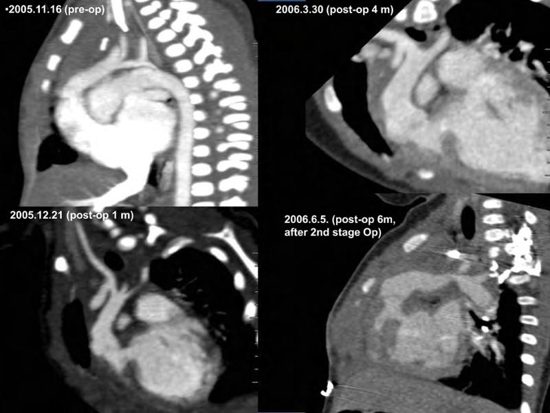 2025 Pediatric Heart Forum Presentation 333페이지