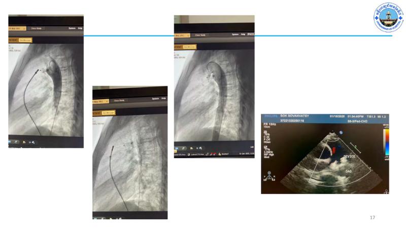 2025 Pediatric Heart Forum Presentation 63페이지