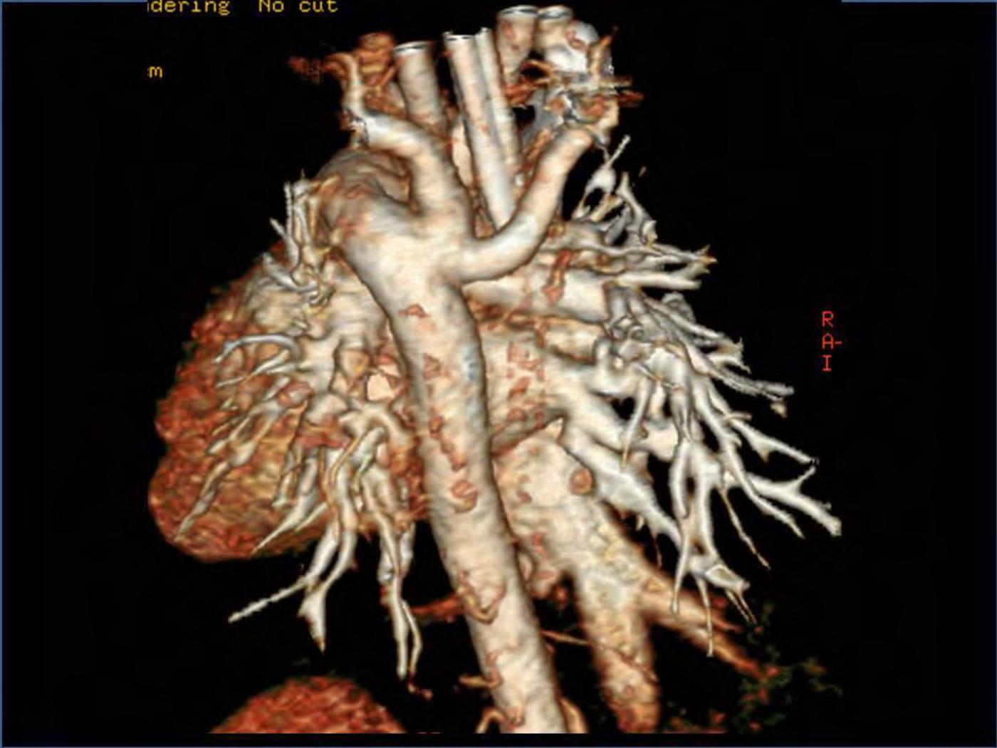 2025 Pediatric Heart Forum Presentation 335페이지